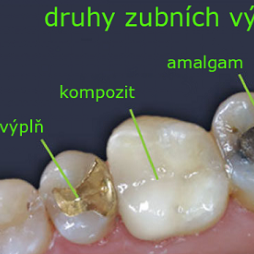 Druhy zubních výplní a jejich výhody a nevýhody